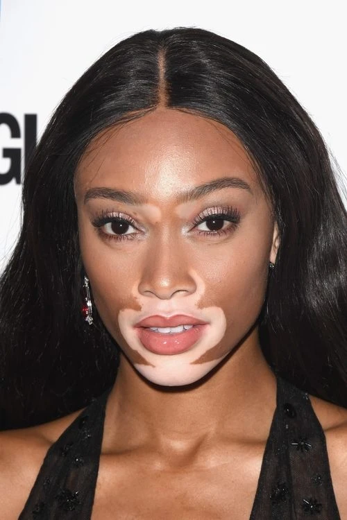 Winnie Harlow